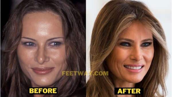 Melania Trump Plastic Surgery & Weight Gain Details With Before After Pics